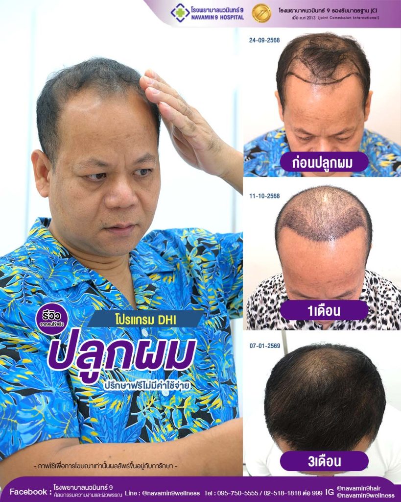 navamin9-ปลูกผมDHI-ชาย-04-07-01-