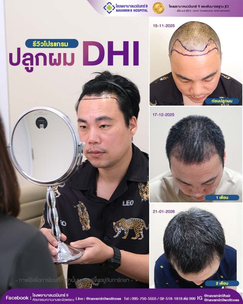 navamin9-ปลูกผม-ชาย-9-12-21-01-