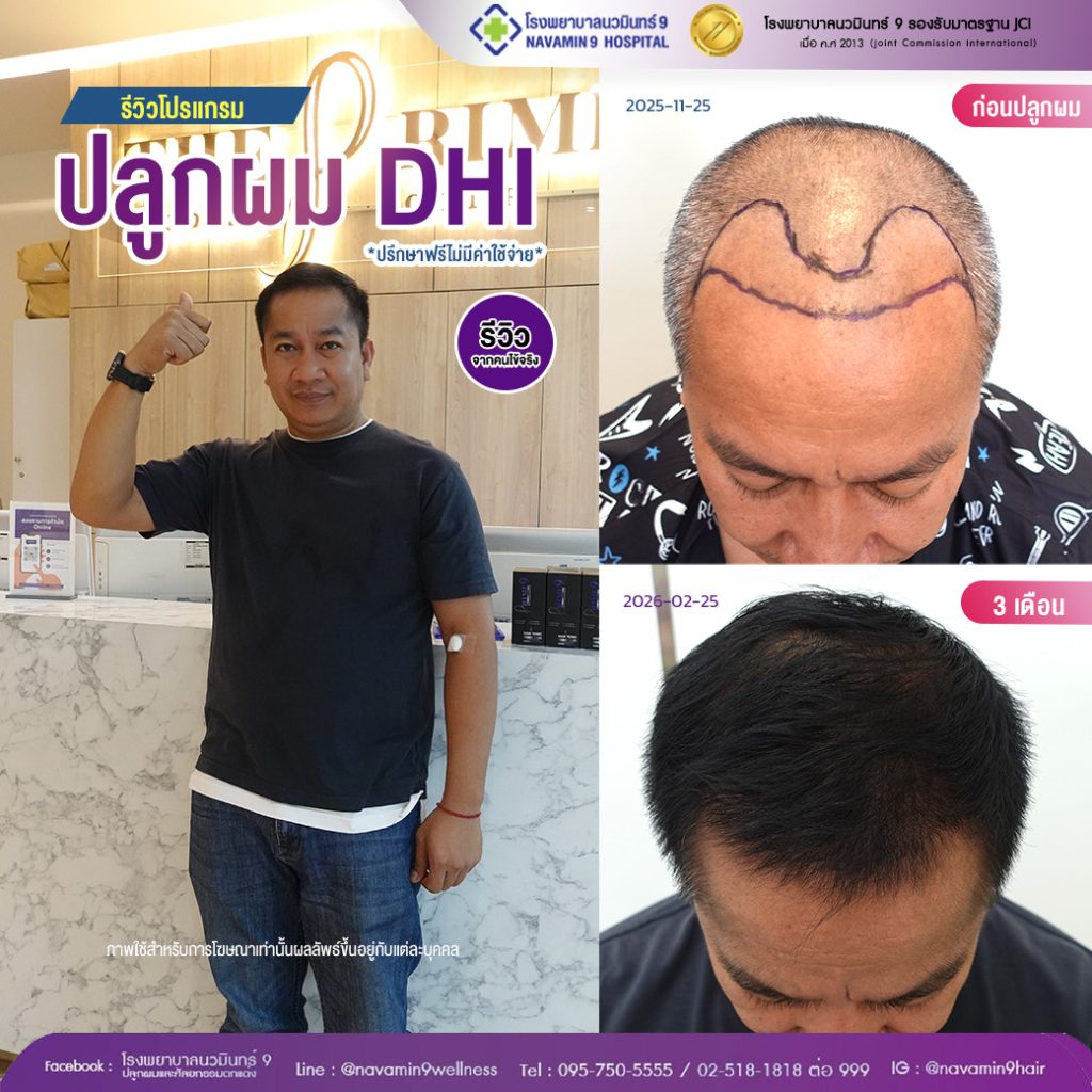 navamin9-ปลูกผมDHI-ชาย-44-2/25jpg