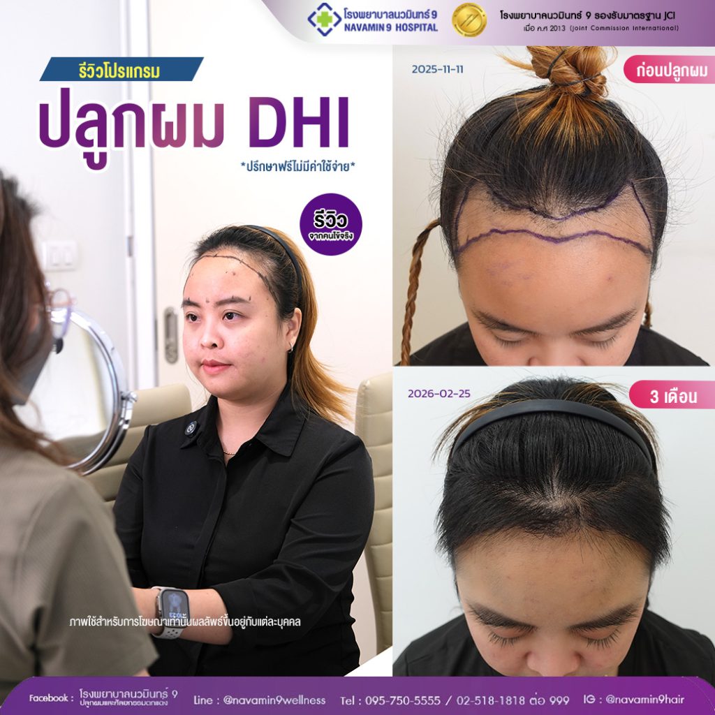 navamin9-ปลูกผมDHI-หญิง-46-2/25
