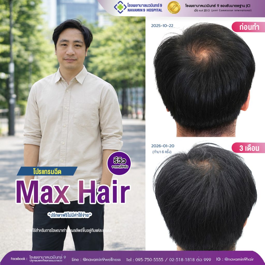 navamin9-01-ชาย-โปรเเกรมmax hair