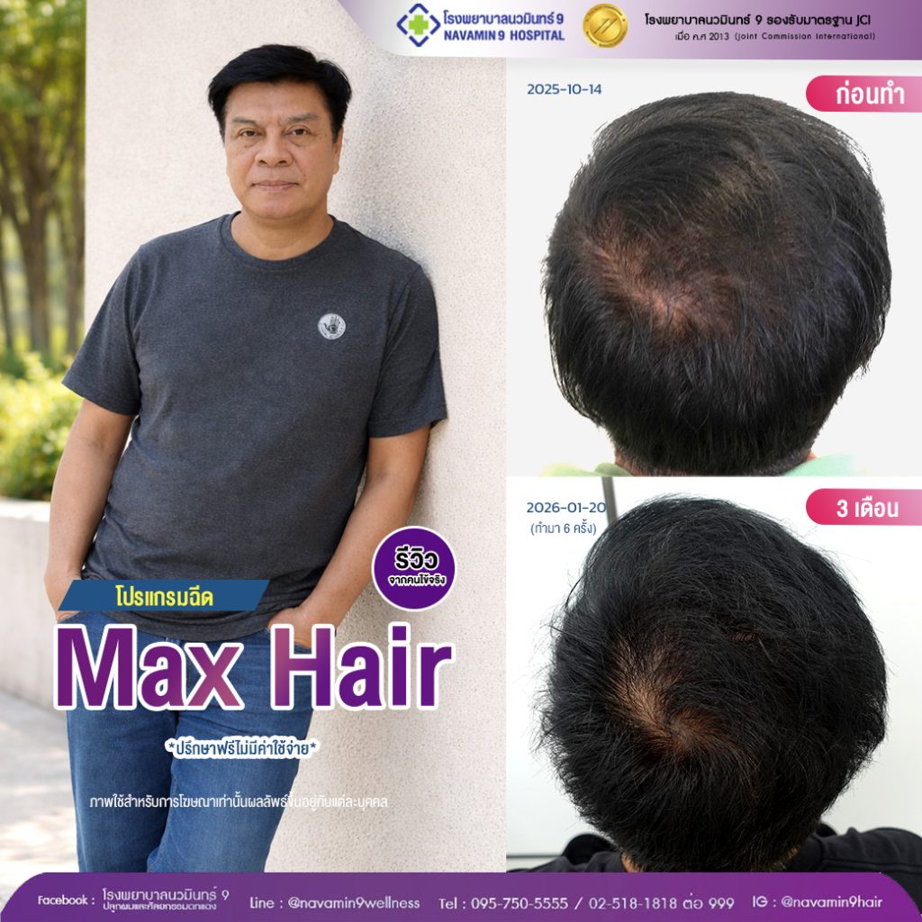 navamin9-02-ชาย-โปรเเกรมmax hair