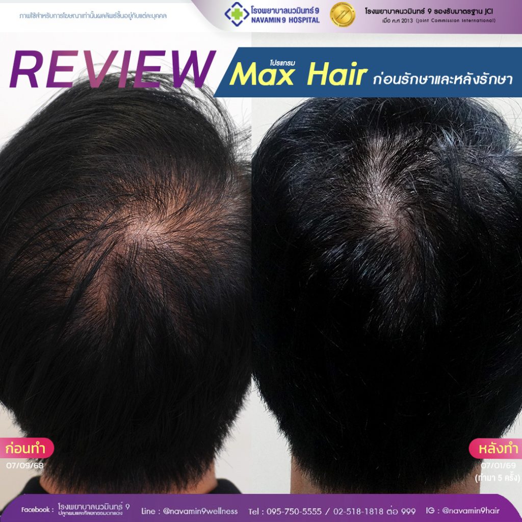 navamin9-โปรเเกรมmax hair-ชาย-05-07-01-