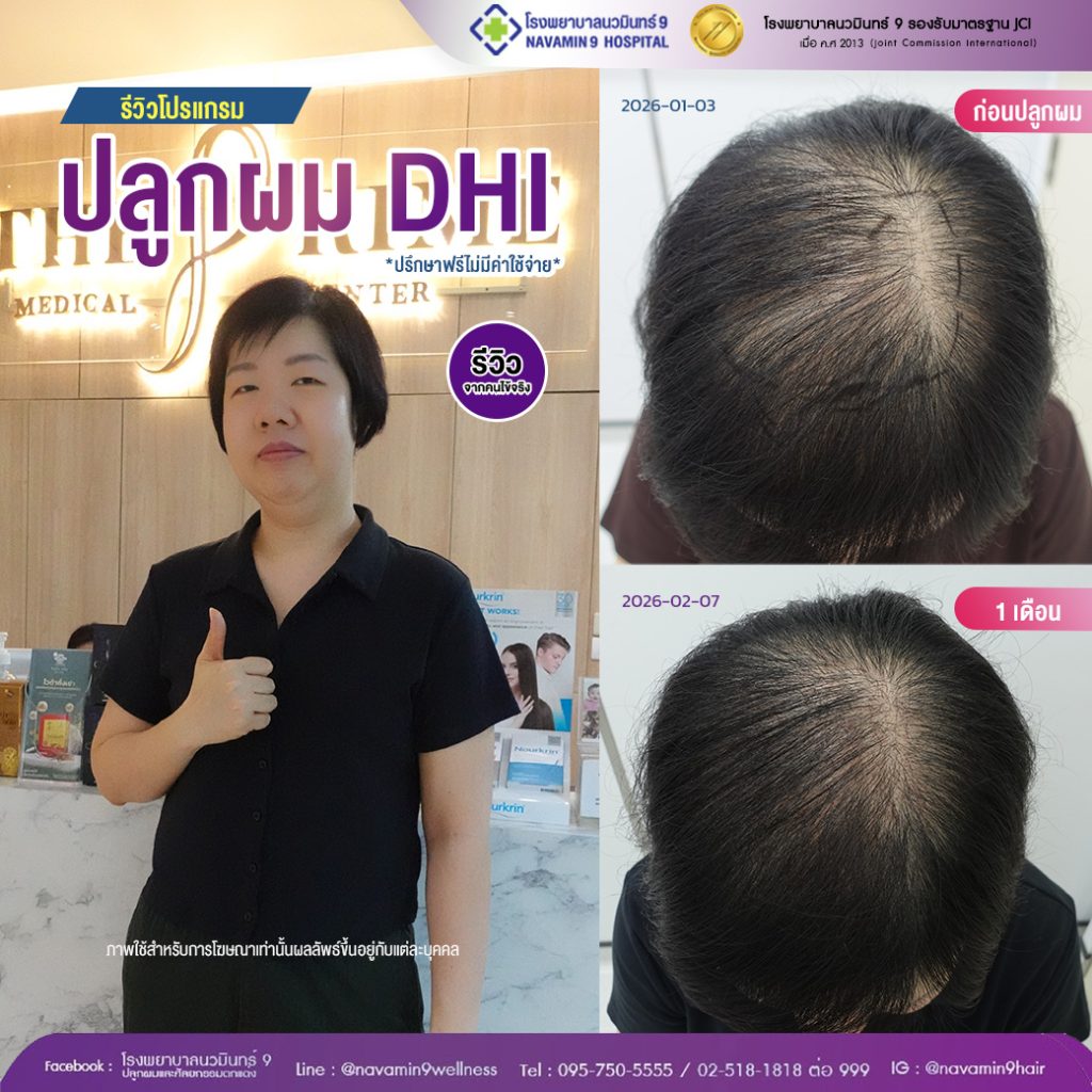 navamin9-ปลูกผมDHI-หญิง-10-02:07