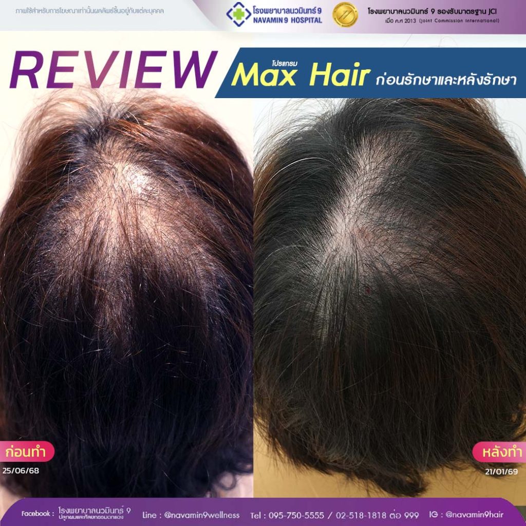 navamin9-โปรเเกรมmax hair-หญิง-9-11-21-01