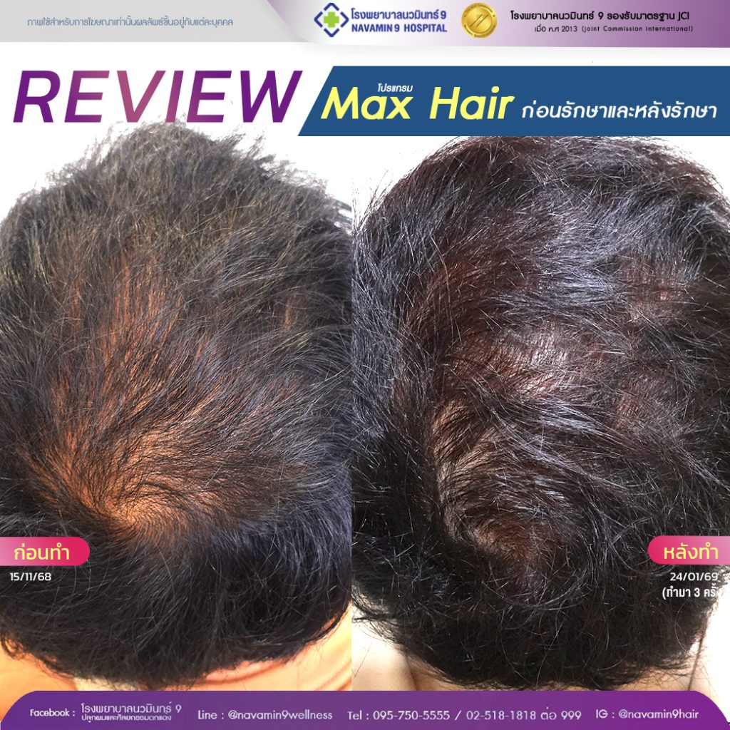 navamin9-โปรเเกรมmax hair-ชาย-15-24-01