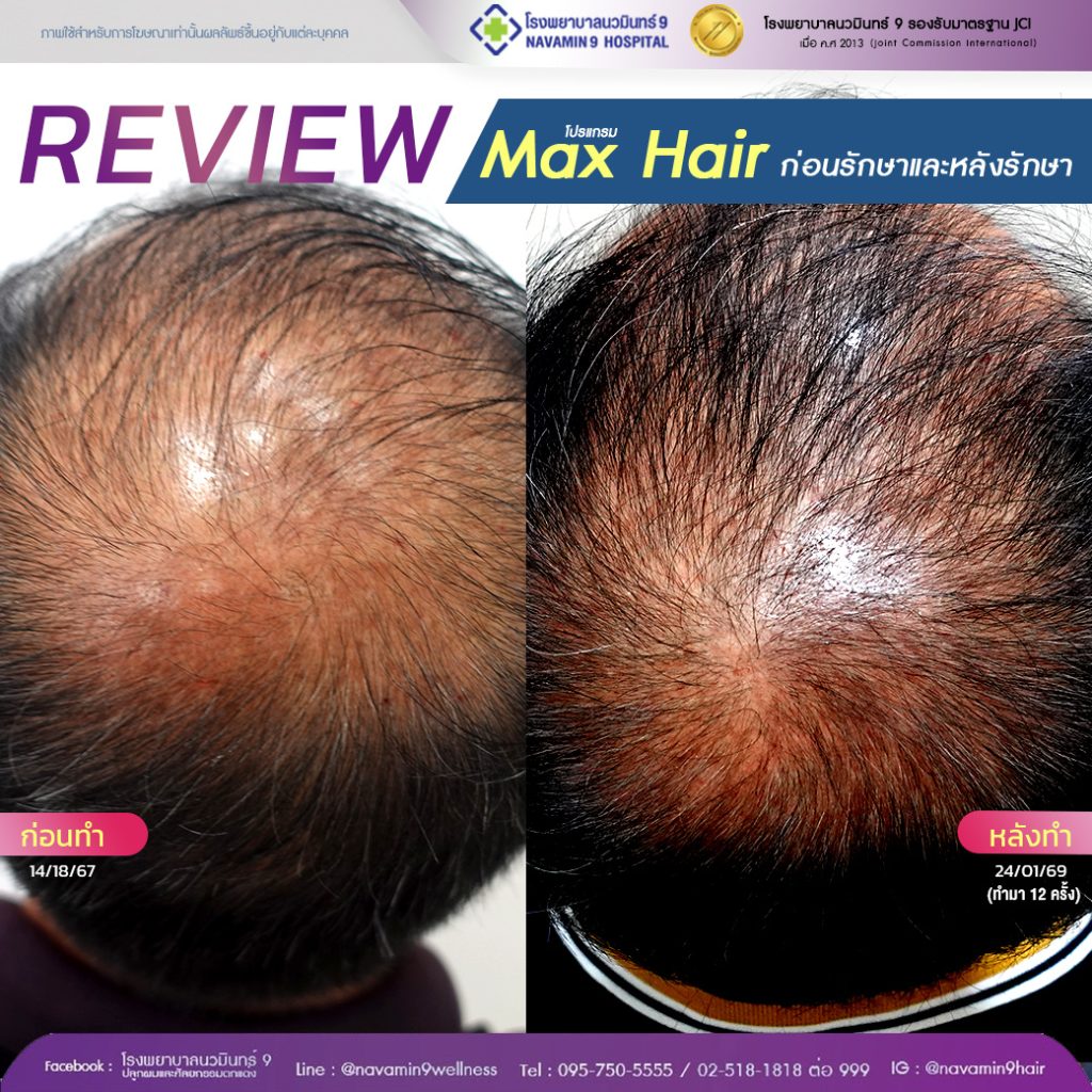 navamin9-โปรเเกรมmax hair-ชาย-16-24-01