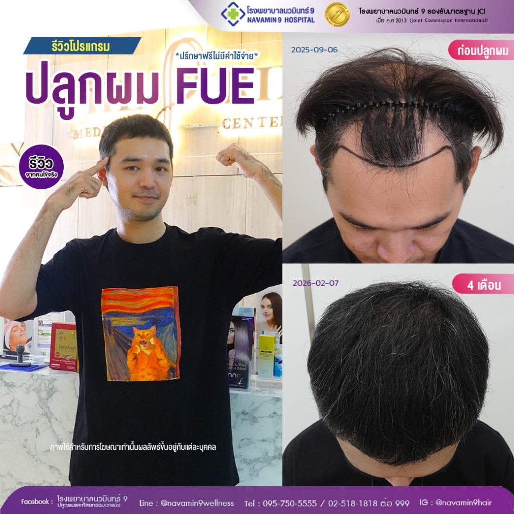 navamin9-ปลูกผมFUE-ชาย-08-02:07