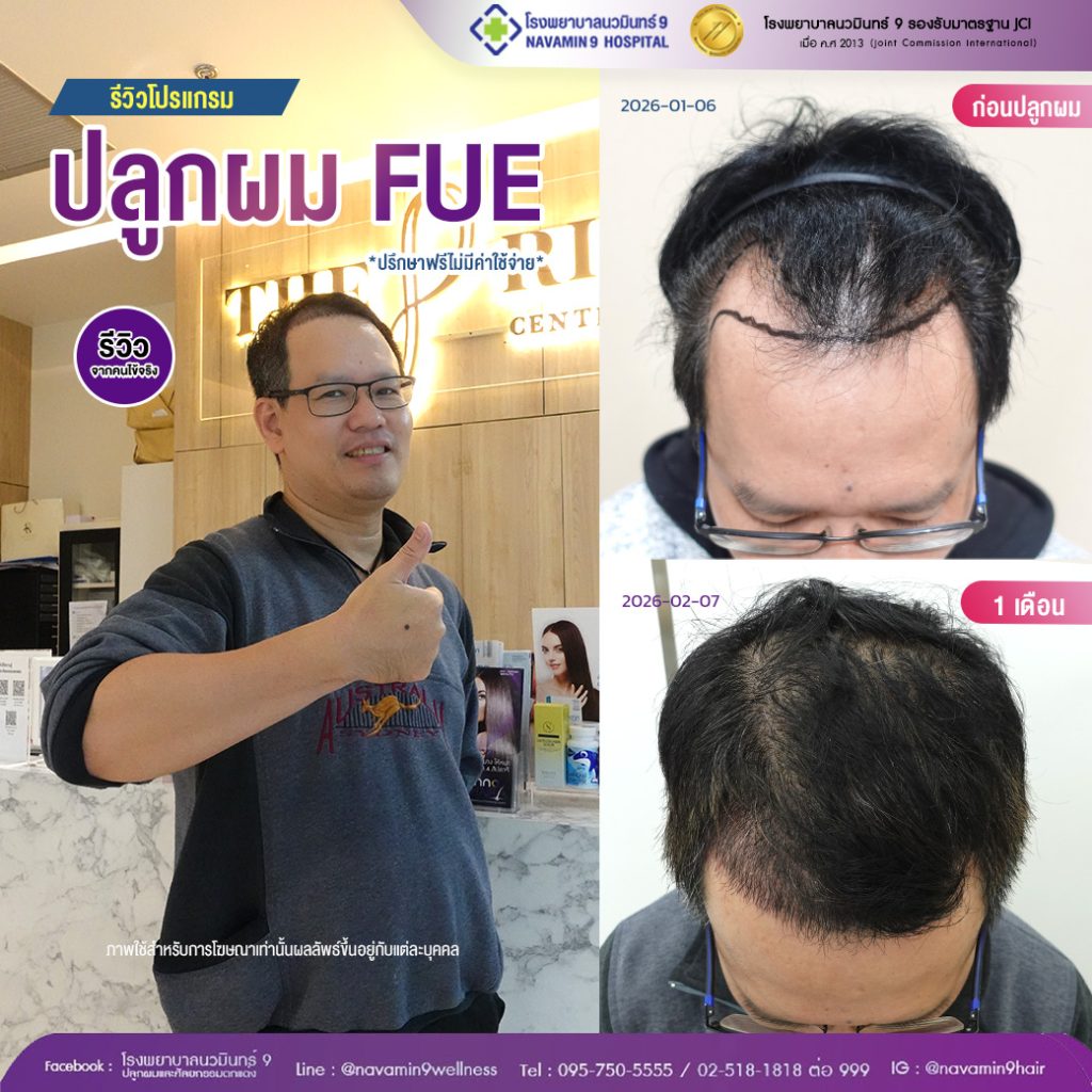 นวมินทร์9-ปลูกผมFUE-09-02:07