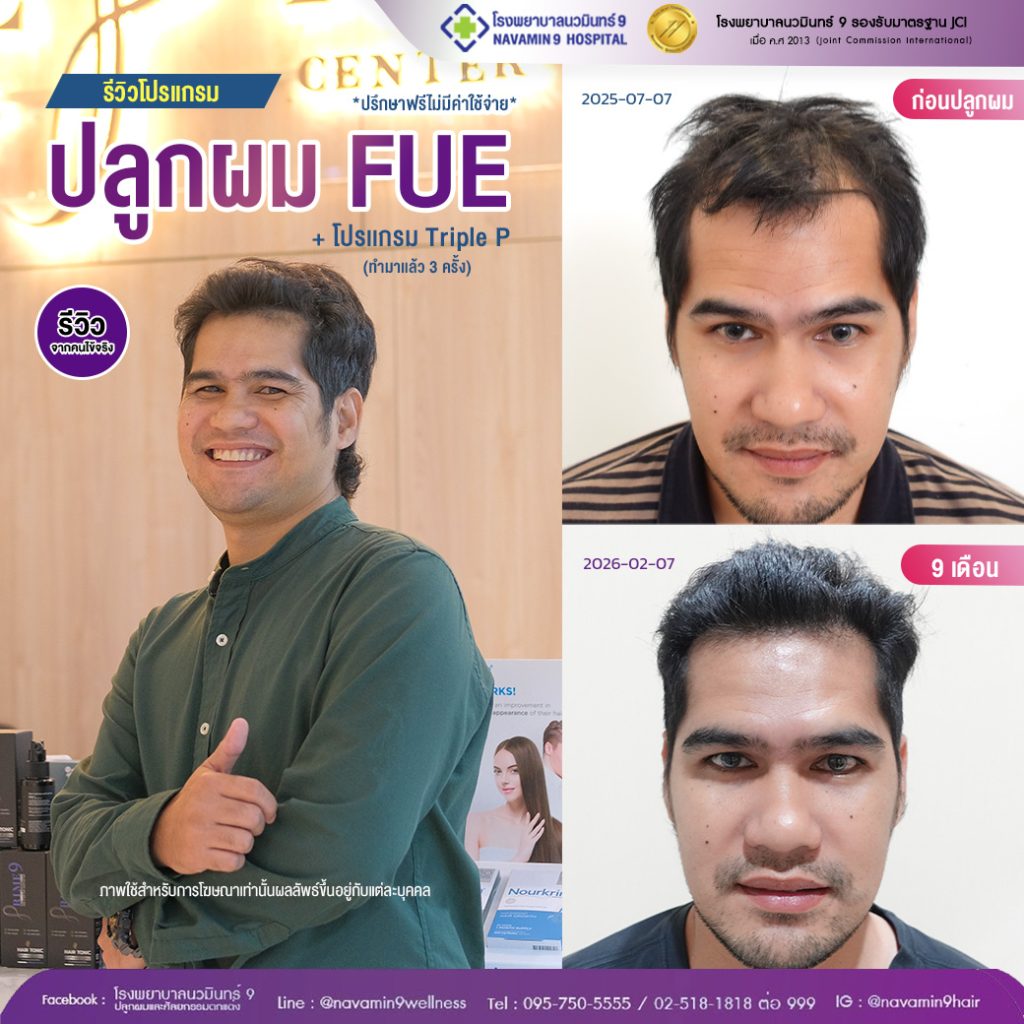 นวมินทร์9-ปลูกผมFUE-ชาย-12-02:10