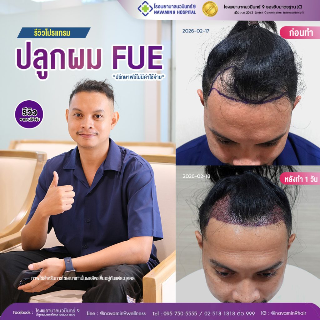 นวมินทร์9-ปลูกผมFUE-ชาย-25-2:17