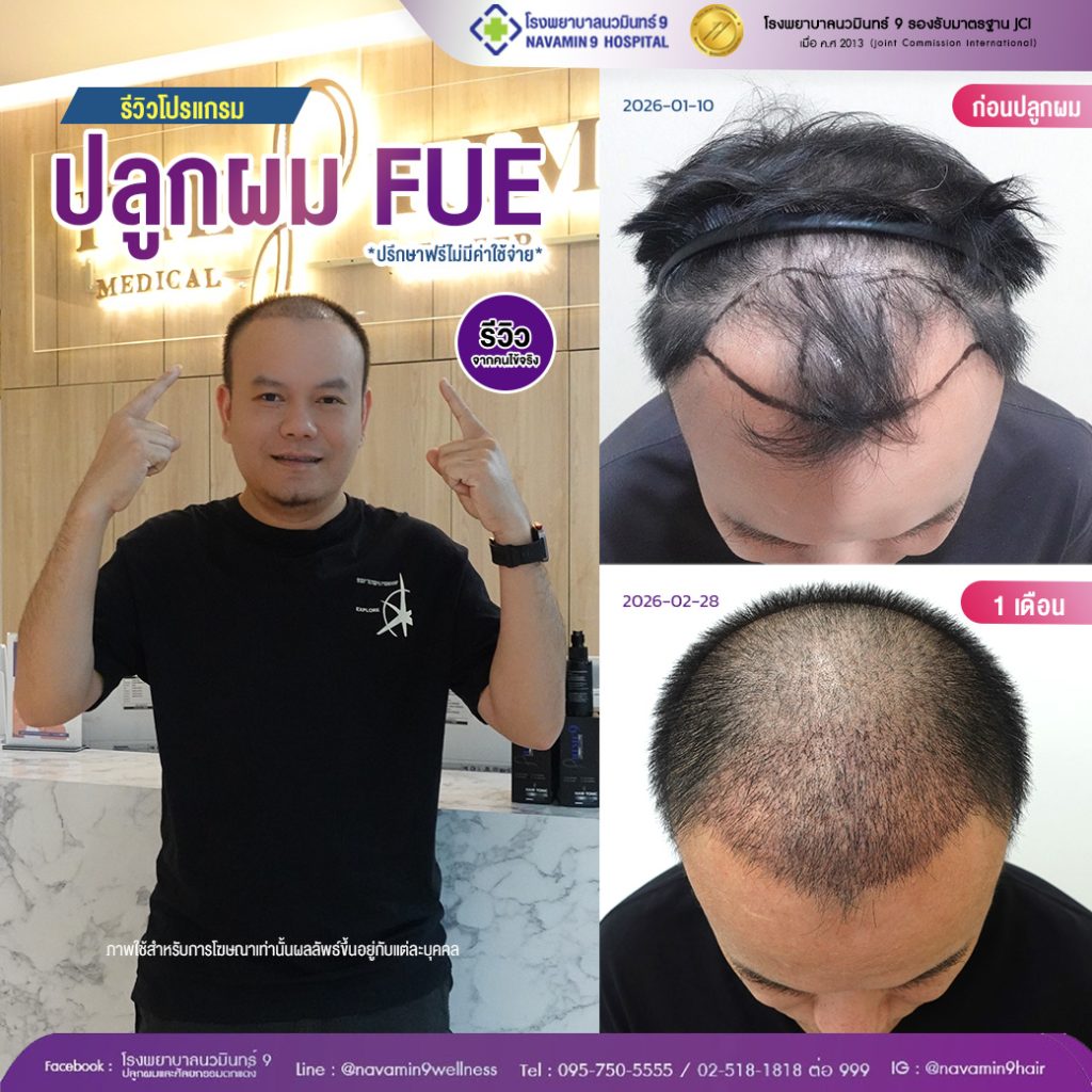 นวมินทร์9-ปลูกผมFUE-ชาย-37-2:28